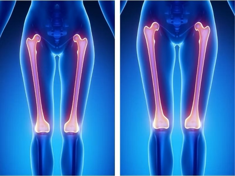 Benefits of Limb Lengthening Procedure