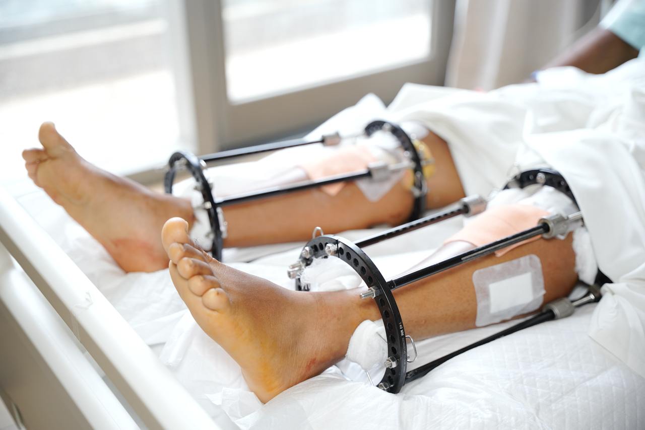 Bilateral Tibia Lengthening Surgery