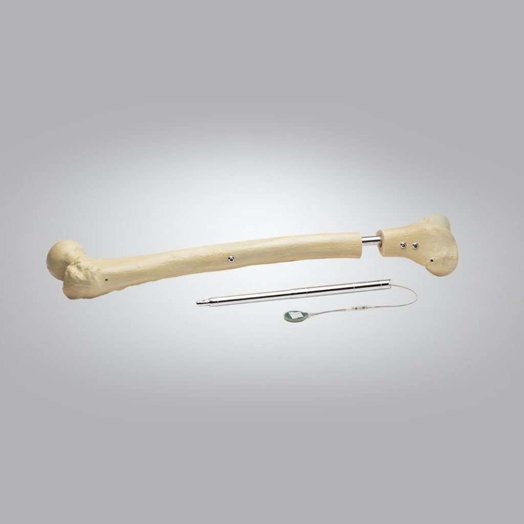 Fitbone Intramedullary Lengthening System