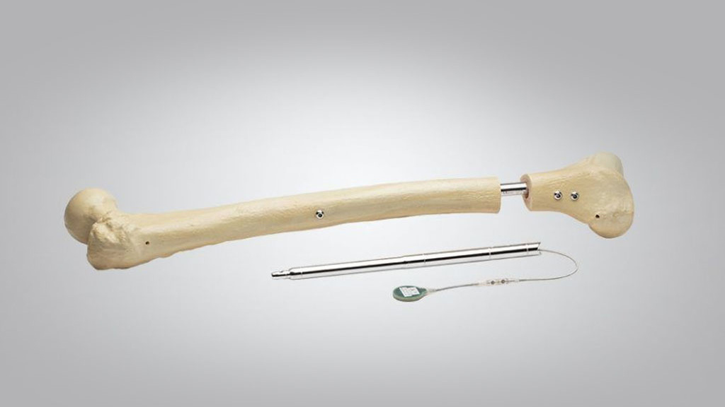 Internal Limb Lengthening Device