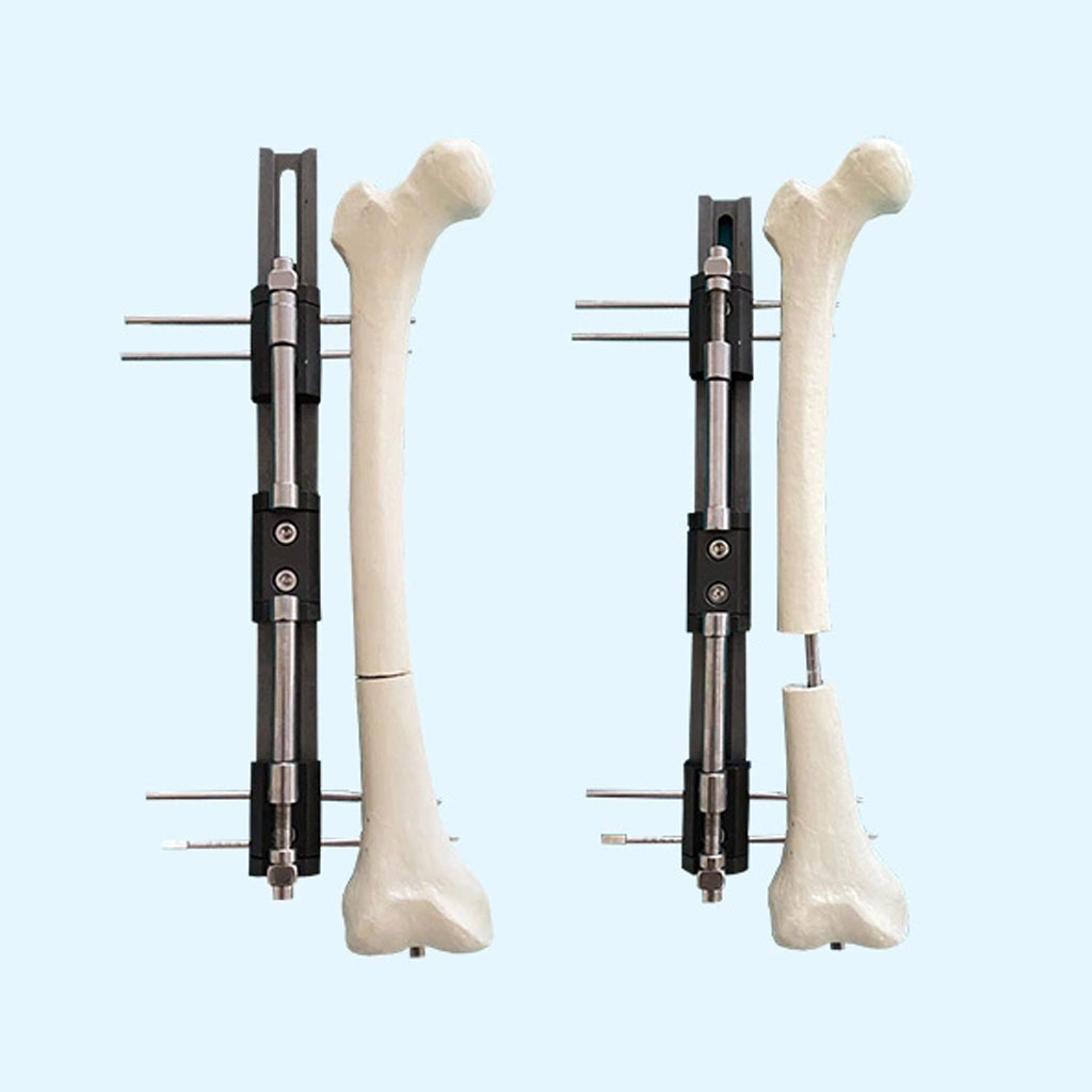 Lengthening And Then Nailing Procedure