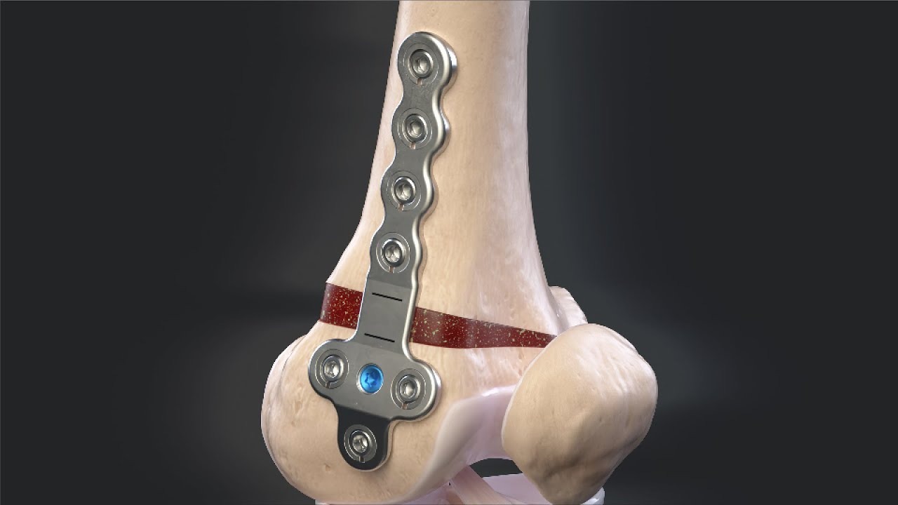 Lower femoral osteotomy DFO knee realignment surgery