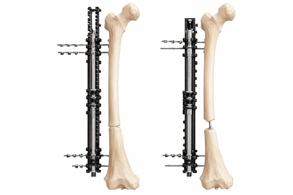 Height Increase and Limb Lengthening Procedure